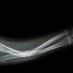 Graphene promises to repair broken bones faster and even prevent a fracture.