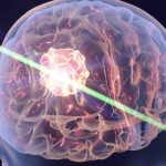 Doctors suggest treating Alzheimer's with a laser