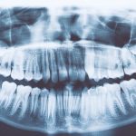 En indisk dreng fandt 526 ekstra tænder. Hvad er denne sygdom?