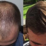 How is a hair transplant done?