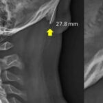 What causes bone sprouts to grow on people's necks?