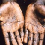 Monkeypox is spreading around the world. How dangerous is she?
