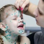 People who have had chickenpox can suffer from facial paralysis