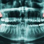 Навіщо потрібні зуби мудрості і чи їх треба видаляти?