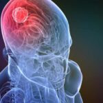 Le cancer du cerveau peut être traité avec des ondes sonores